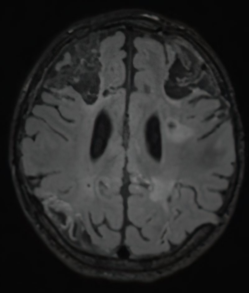 Axial MRI, T2 FLAIR sequence, showing chronic bilateral watershed infarcts.