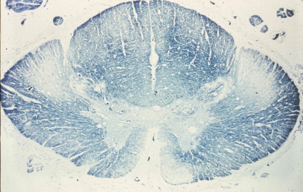 motor neuron disease amyotrophic lateral sclerosis spinal cord cross section