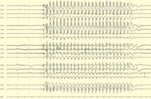 Epilepsy Absence seizure with 3 Hz spike and wave