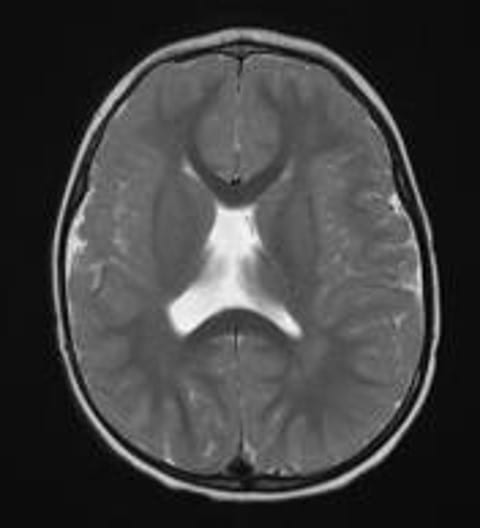 Brain MRI with absent septum pellucidum in patient with septo-optic dysplasia