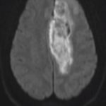 AcuteACAinfarct_MRIaxia_DWI-1.jpg