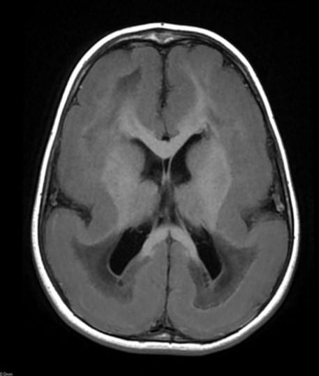 Axial MRI showing a near-complete absence of cortical sulci 