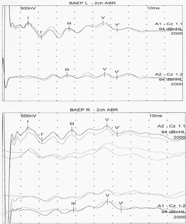 Evoked Potentials How to Read BAEP/BAERs, VEPs, SSEPs