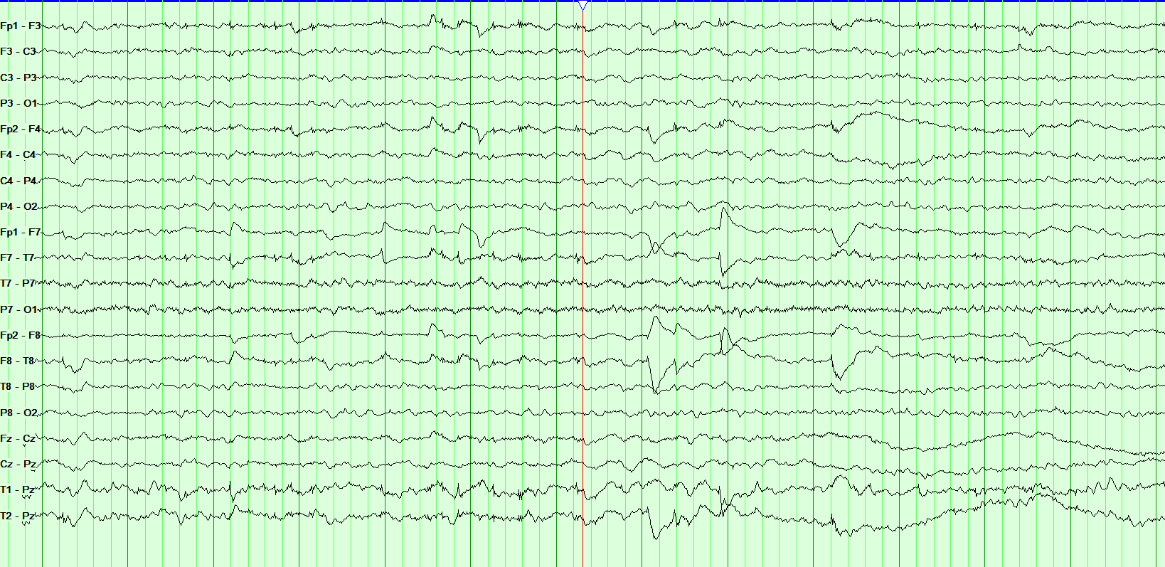 Sleep Disorders Neuro Review Chapter and Quiz NowYouKnow Neuro