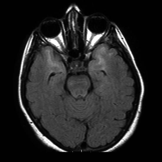 CADASIL seen on Brain MRI, showing white matter T2 hyperintensities in the pole of the anterior temporal lobe, external capsule and subcortical white matter.