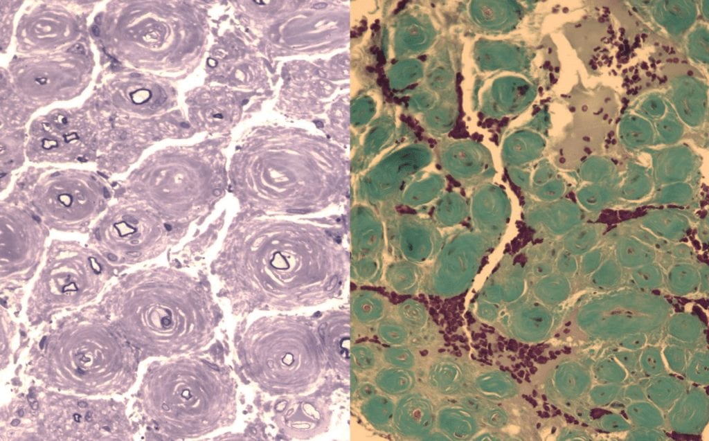 Nerve biopsy of a patient with CIDP showing onion bulb pathology