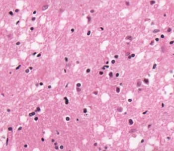 H&E stain showing many small round vacuoles consistent with spongiform encephalopathy.