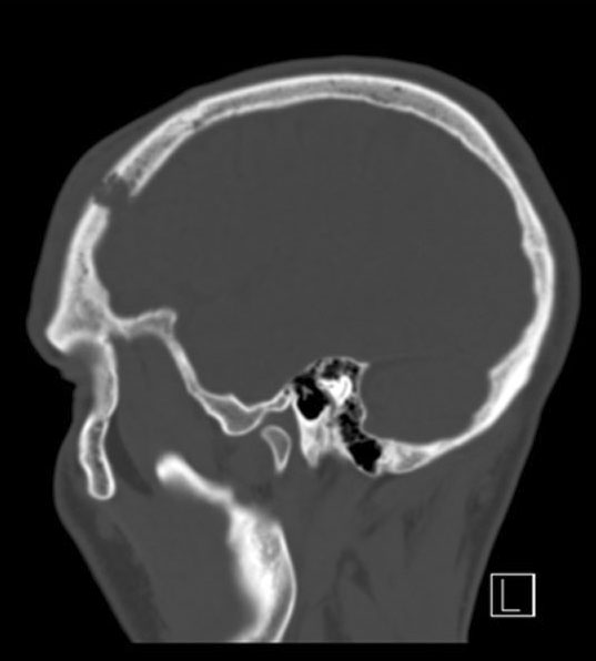 CT brain scan showing a lytic lesion on the skull