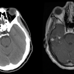 CTH-and-T1-w-contrast-oligodendroglioma.jpg.png