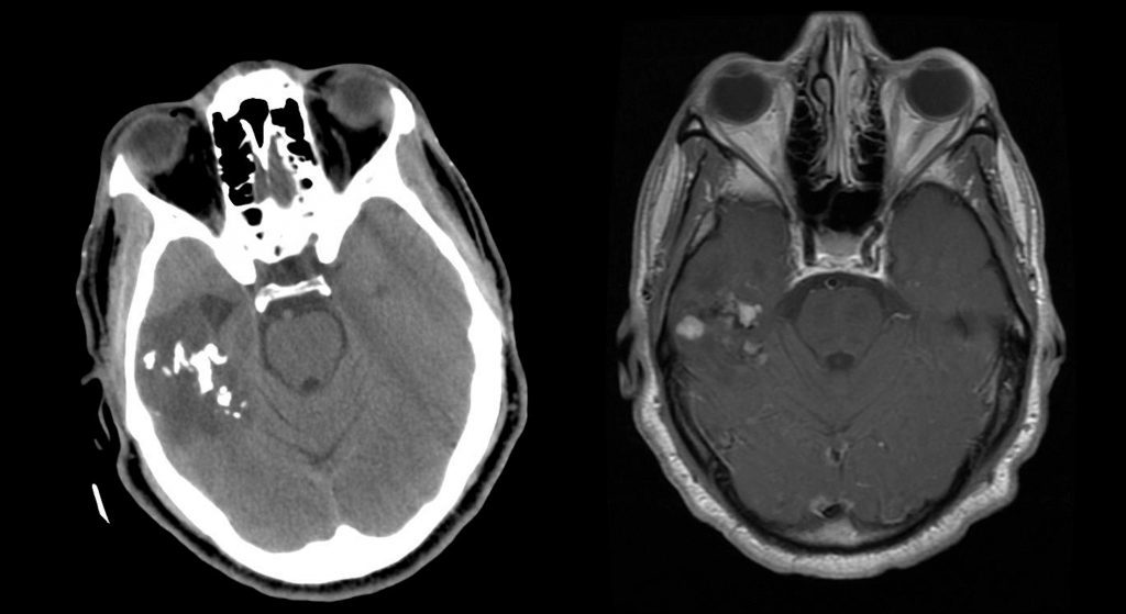 Oligodendroglioma, neuro-oncology, tumor