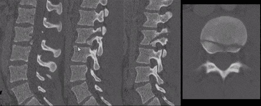 Chance Fracture on Sagittal view of lumbar spine