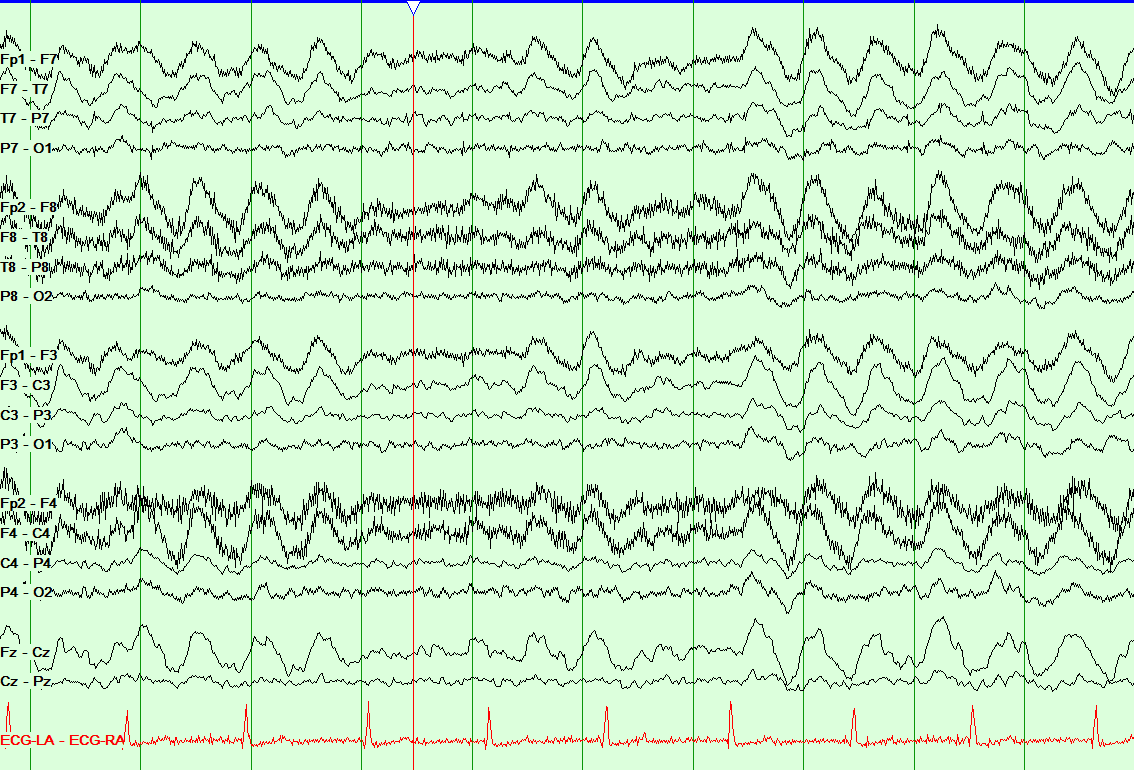 EEG | NowYouKnow Neuro