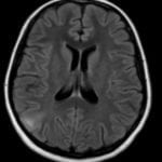 Epilepsy patient MRI with focal cortical dysplasia