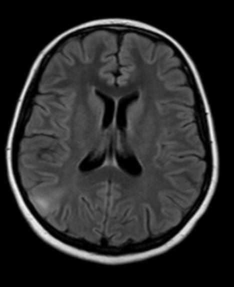 Epilepsy patient MRI with focal cortical dysplasia