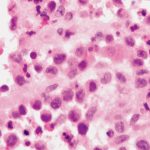 HE-high-power-langerhans-cell-histiocytosis-1.jpg