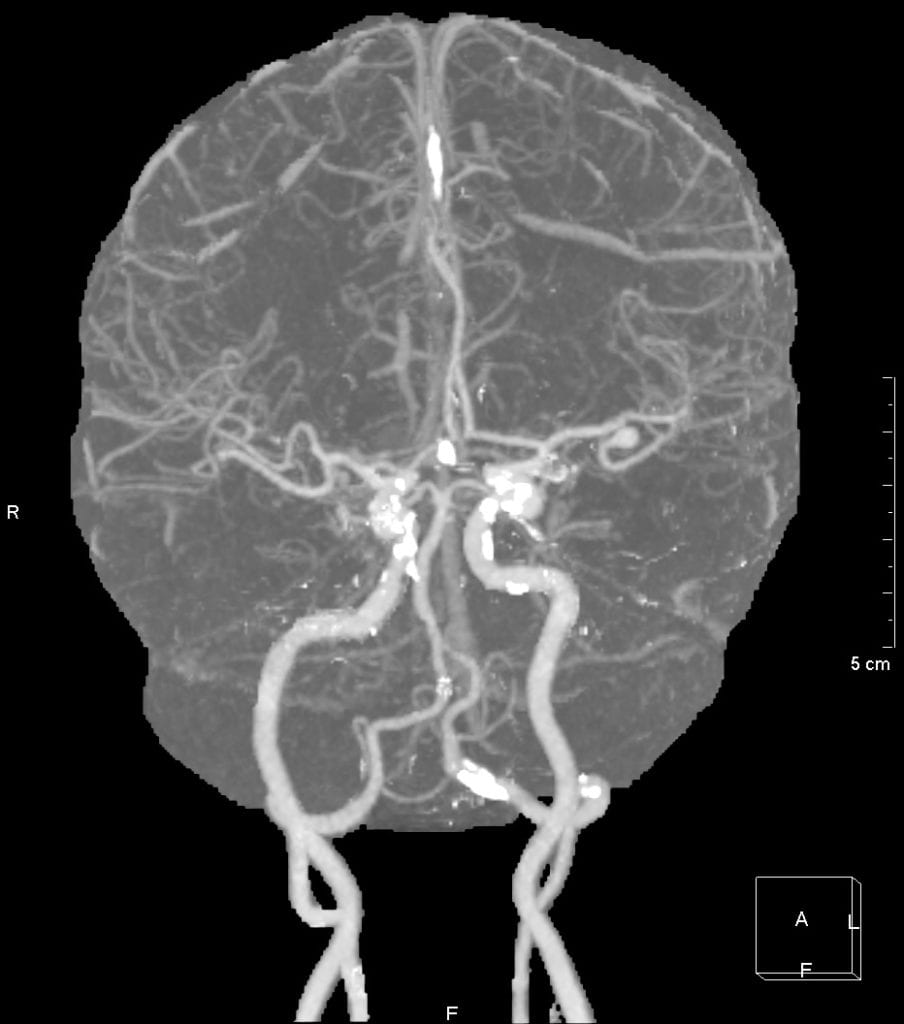 MRA showing a Left MCA Aneurysm, cerebral vascular anatomy
