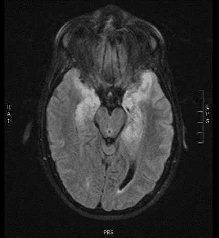 Axial MRI T2 FLAIR with bilateral temporal lobe hyperintensity consistent with Herpes (HSV) Encephalitis