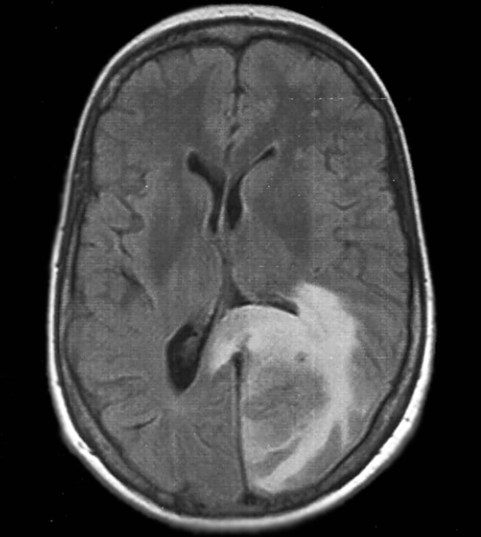 MRI Brain with left posterior cerebral artery ischemic stroke affecting the left occipital lobe and splenium of the corpus callosum causing alexia without agraphia