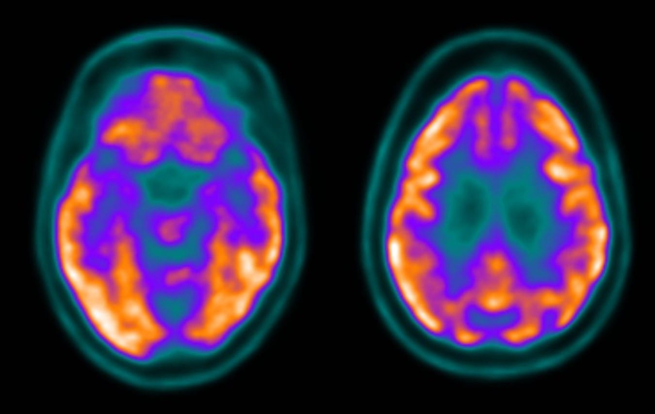 Neurodegenerative Disorders