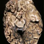 Rasmussens-encephalitis-gross-2.jpg