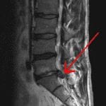 Sagittal MRI spine showing S1 Disc Herniation