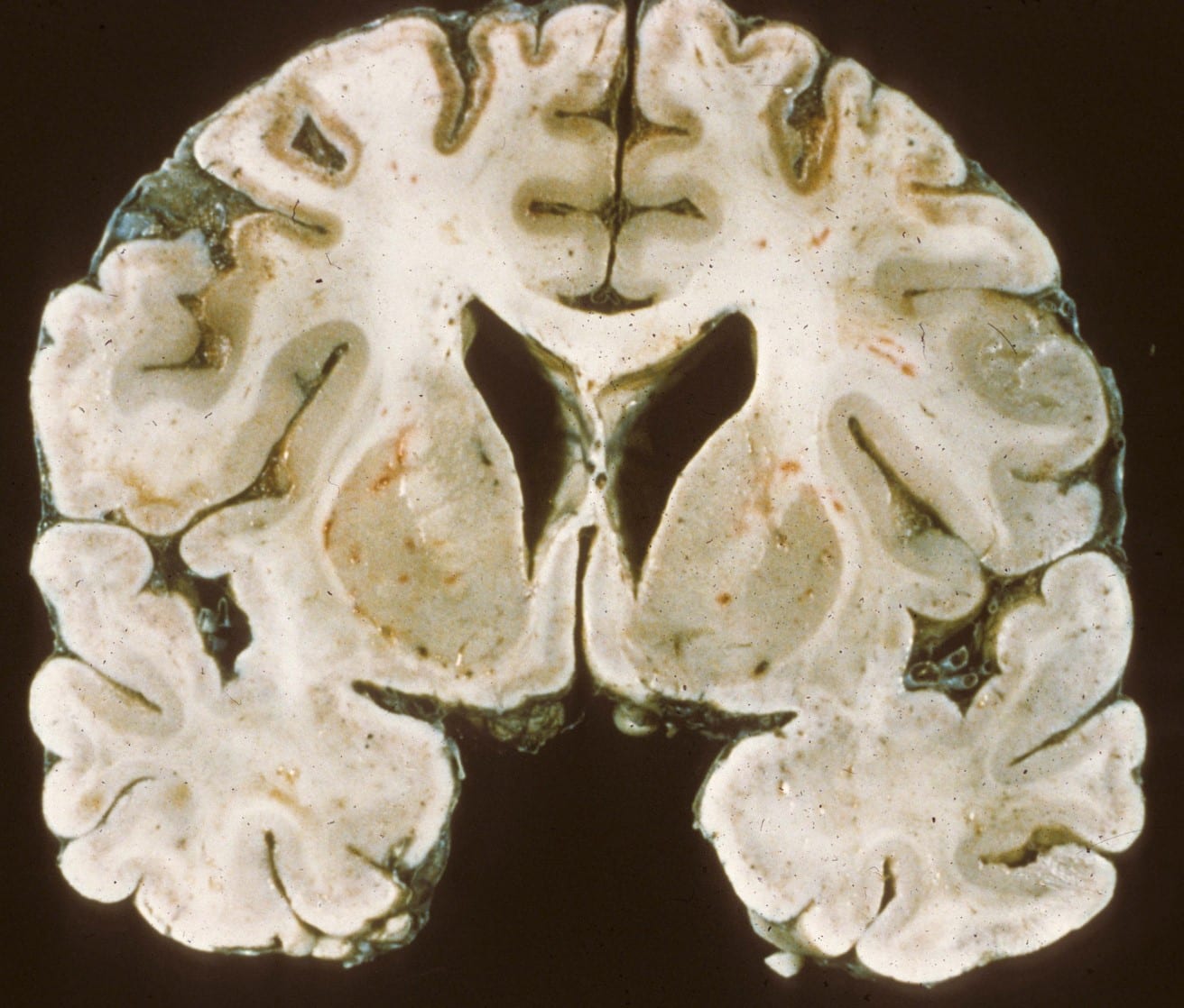 Bilateral ischemia on gross coronal section of brain