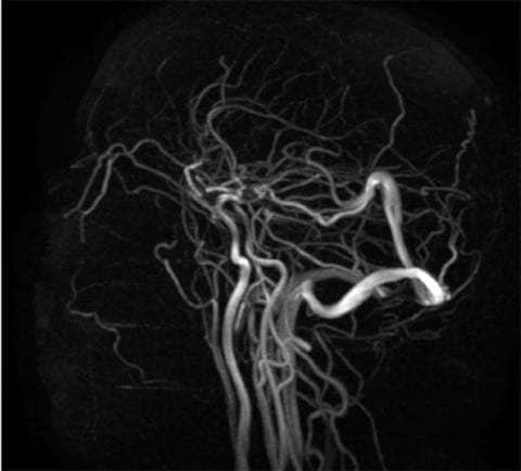 MR venogram show a paucity of flow in the superior sagittal sinus consistent with superior sagittal sinus thrombosis