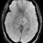 TumefactiveNMOSD_MRI_SWI-1.jpg