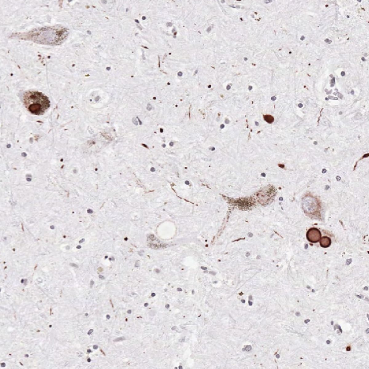 Dementia & Neurodegeneration NowYouKnow Neuro