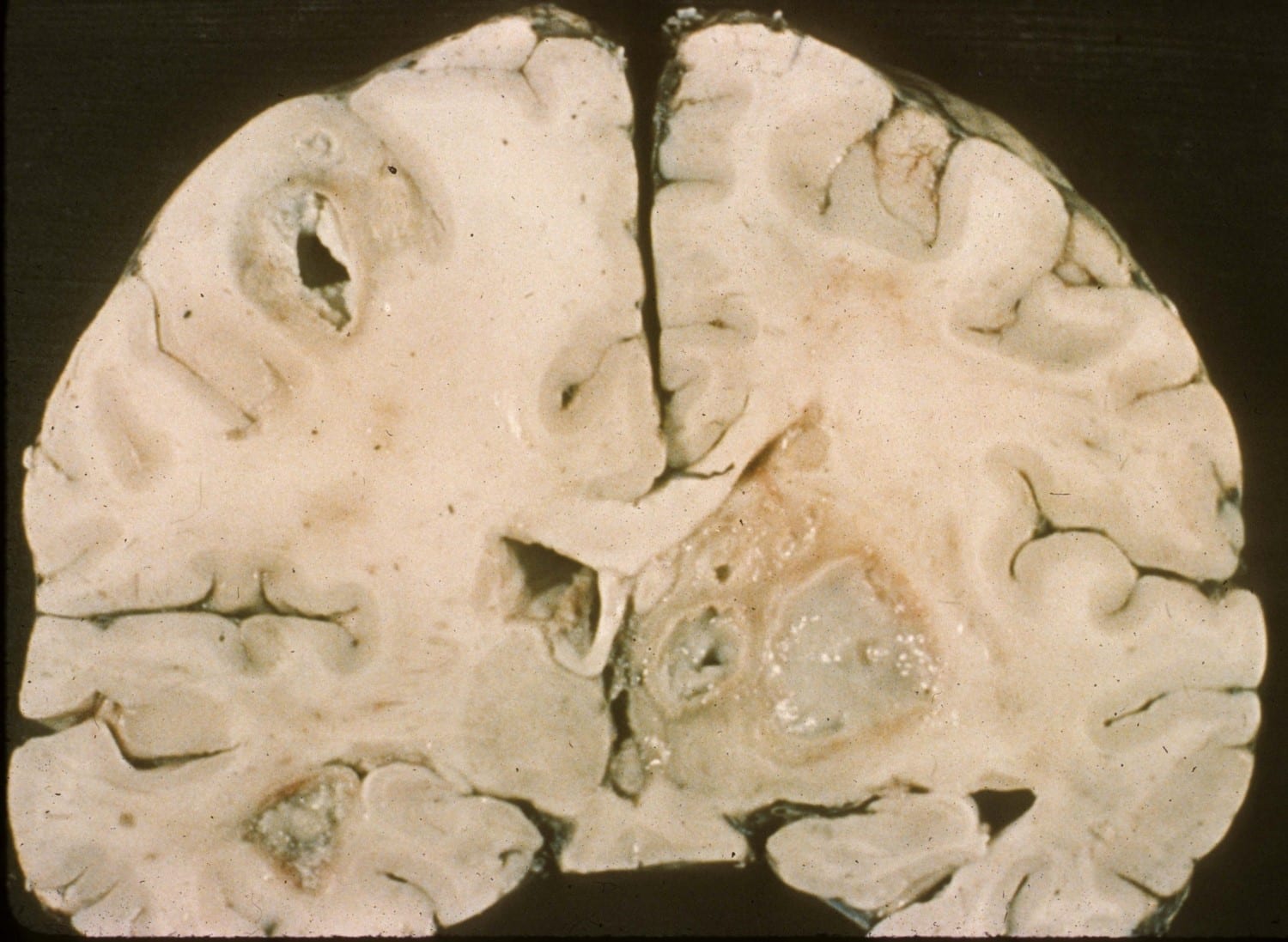 Coronal section showing multiple well-circumscribed brain lesions