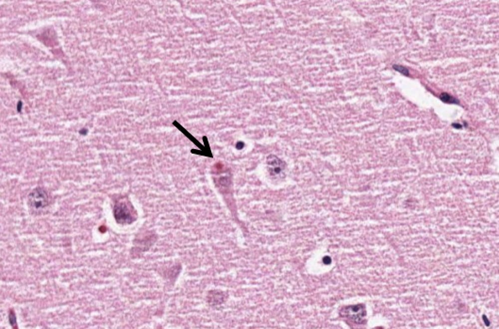 Alzheimer's Disease patient pathology specimen with an eosinophilic inclusion