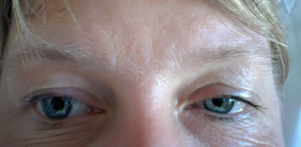 Anisocoria Left eye miosis and ptosis secondary to Horner's syndrome