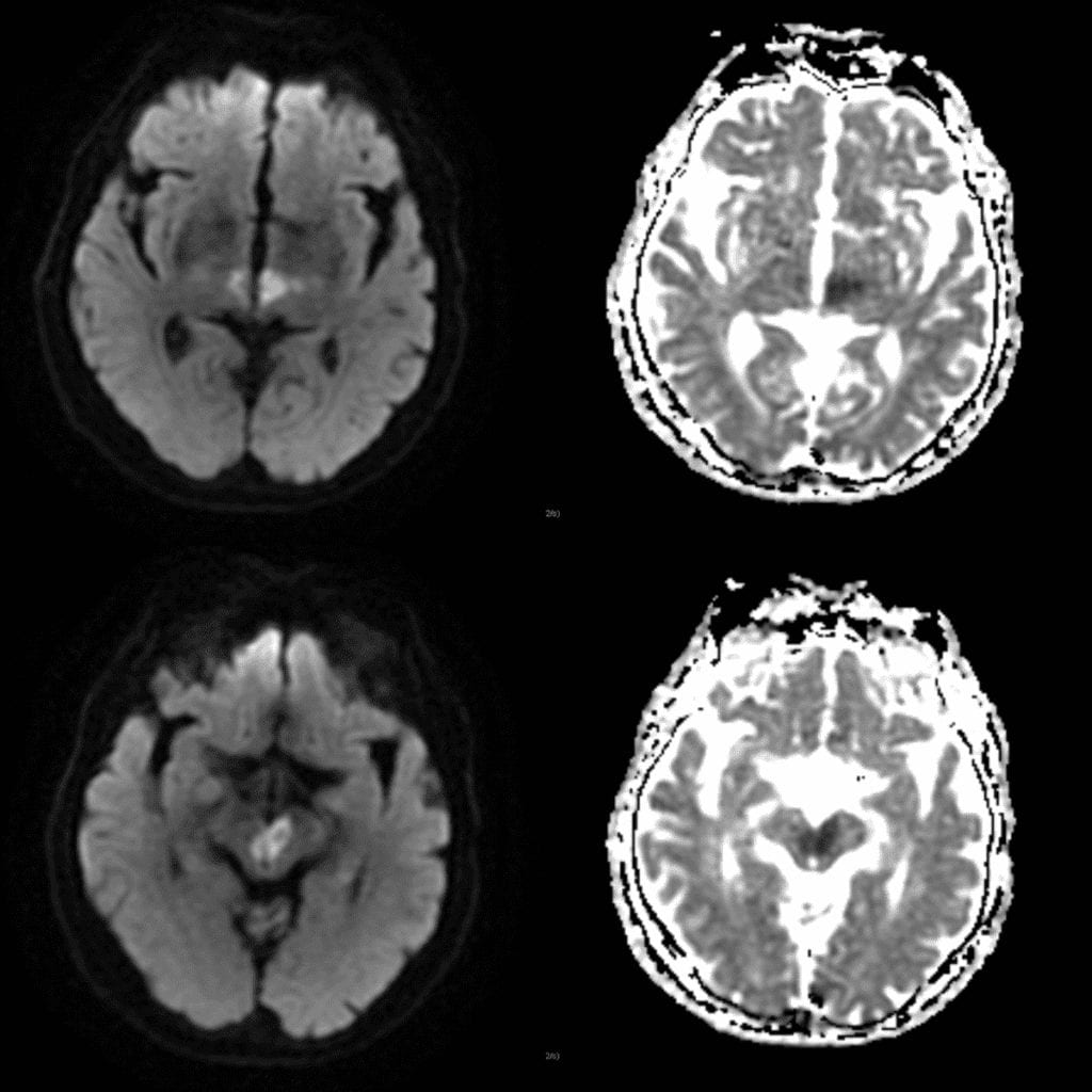 Axial MRI brain DWI and ADC showing an Artery of Percheron Stroke with Bilateral thalamus and bilateral midbrain diffusion restriction