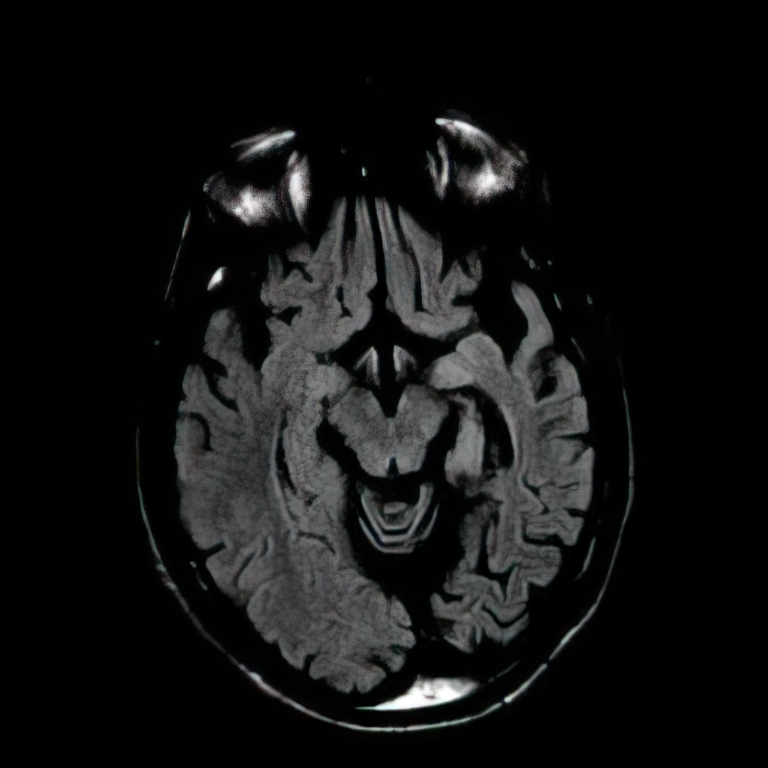 Rasmussen's encephalitis Axial T2 MRI showing asymmetric atrophy