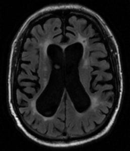 Vascular Dementia on brain MRI with T2 flair with both patchy hyperintensity and diffuse atrophy