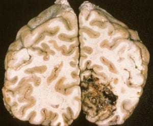 Arteriovenous Malformation on brain gross specimen
