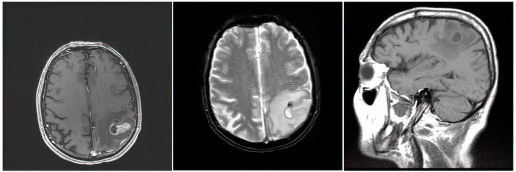 Neuroinfectious disease Cerebral Abscess on MRI