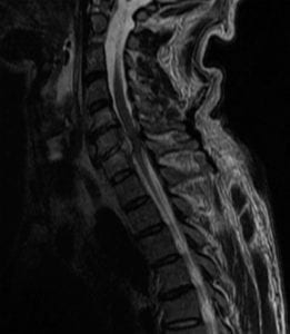 Epidural Abscess at C6 on Sagittal spine MRI