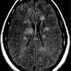 Multiple Sclerosis Plaques MRI T2 Flair with numerous multiple sclerosis plaques.