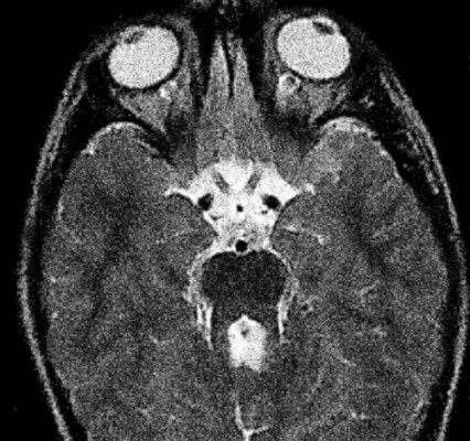 Hereditary and Metabolic Disorders Discussion: This clinical picture describes a typical presentation and MRI findings of Joubert syndrome; in which there is hypoplasia of the cerebellar vermis. The most common features of this syndrome include hyperpnea, hypotonia, oculomotor apraxia, ataxia, and intellectual disability. Other neurologic manifestations include seizures. The molar tooth sign, which is the result of the thickening and horizontalization of the superior cerebellar peduncle and a deep interpeduncular fossa, can also be seen in several other disorders including Dekaban-Arima syndrome, Senior-Loken syndrome, and COACH (cerebellar vermis hypoplasia, oligophrenia, ataxia, coloboma, and hepatic fibrosis). Cerebellar Vermis Hypoplasia of Joubert Syndrome