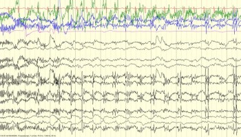 Rattle-Shaking Artifact EEG with Rattle-Shaking Artifact