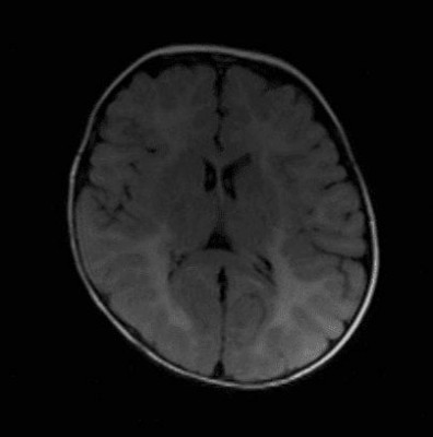 Adrenoleukodystrophy Axial T2 FLAIR MRI showing posterior-predominant white matter hyperintensities consistent with adrenoleukodystrophy