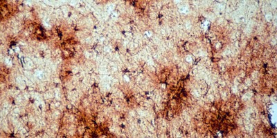 Astrocytes in Alzheimer’s Disease Cortex Pathology slide with Astrocytes in Alzheimer’s Disease Cortex