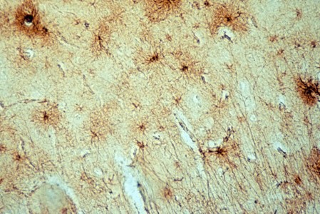 Astrocytes in a Normal Aged Human with GFAP Stain Astrocytes in Normal Aged Cortex on GFAP stain slide