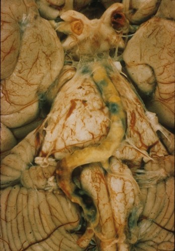 Atherosclerosis Atherosclerosis of the basilar and vertebral arteries on gross pathology