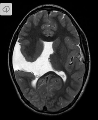 Schizencephaly Neurodiagnostic studies: Axial MRI, T2 FLAIR, showing open-lipped (Type 2) schizencephaly