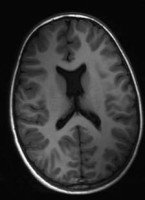 Axial MRI with absence of the Septum Pellucidum