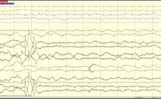 Delta brush EEG with Delta brush