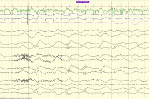 Delta Brush EEG review tracing with delta brush