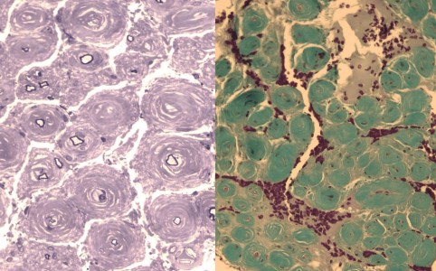 CIDP with Onion Bulbs Nerve biopsy of a patient with CIDP showing onion bulb pathology